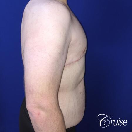 severe gynecomastia - After Image 2