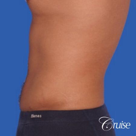 best liposuction to contour a males body - After Image 2