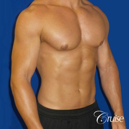 Gynecomastia puffy nipples cost - After Image 2