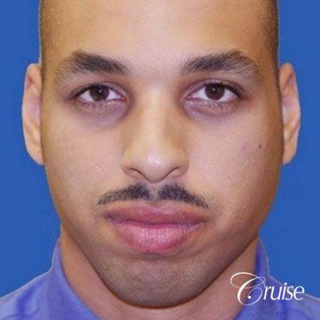 male patient with best pictures of chin implant - Before Image 1