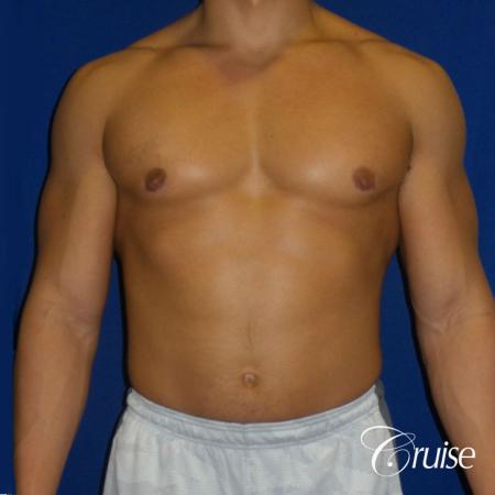 bodybuilder with gynecomastia - After Image 1