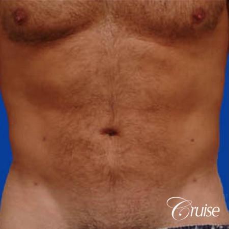 best male ab sculpting liposuction abdomen flanks - After Image