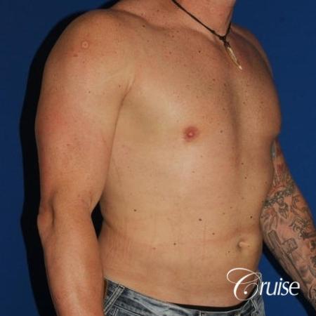 moderate gynecomastia with puffy nipple on athletic adult - After Image 4