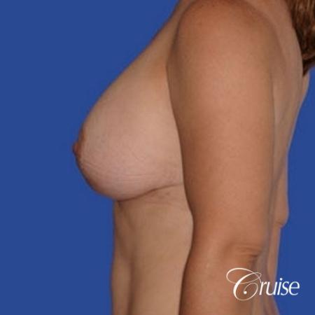 pictures of 42 yr old with breast lift anchor revision - Before Image 2