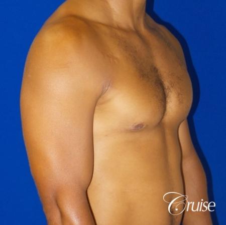 gynecomastia caused by testosterone - After 2