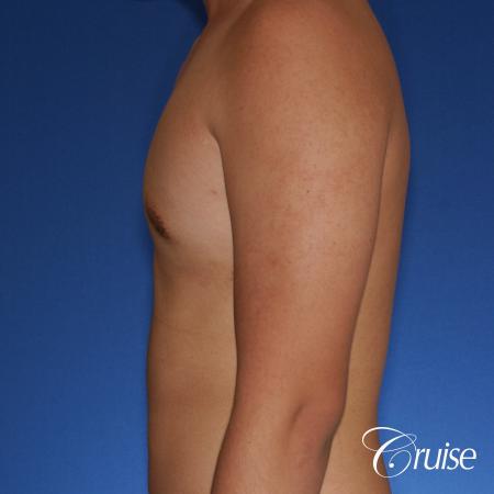 best gynecomastia surgery with plastic surgeon, Dr. Cruise - After Image 2