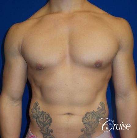 Body Builder Gynecomastia -Areola Incision - After Image 1