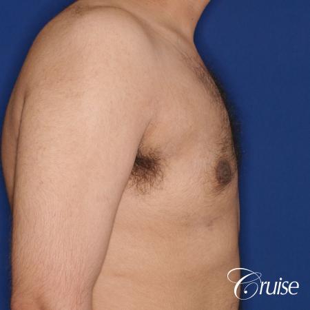 best scar on 32 gynecomastia patient - After Image 4