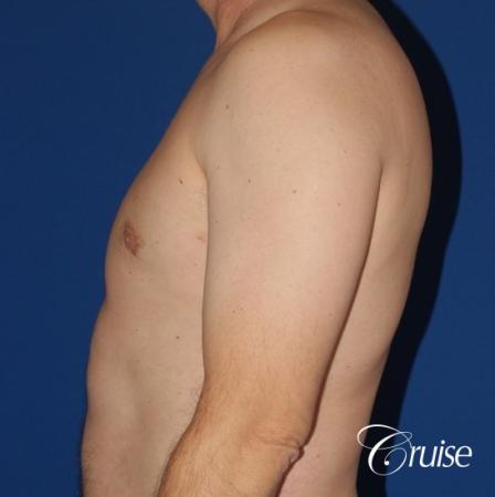 moderate gyne on mature adult 49 - After Image 2