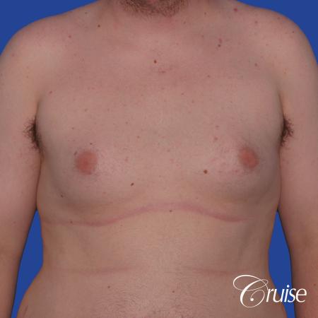 moderate gyne on young male adult - Before Image 1