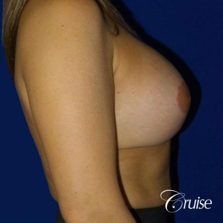 Breast Lift Anchor W/ Silicone Implants On Young Woman - After Image 2