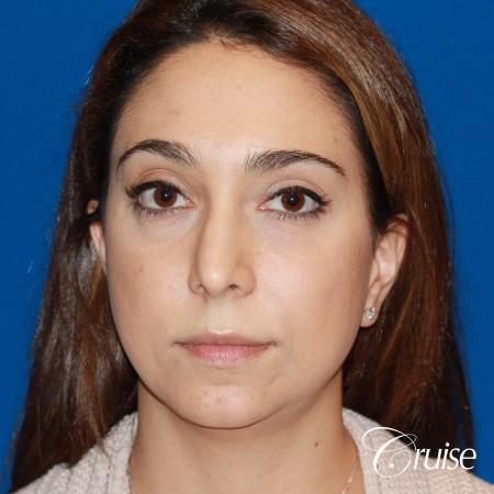 best medium chin implant on young patient - Before Image 1