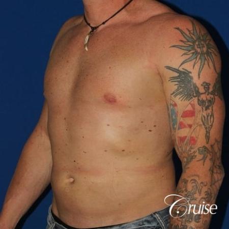 moderate gynecomastia with puffy nipple on athletic adult - After Image 2