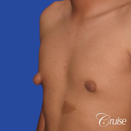 gynecomastia patient gets nipple reduction for best results - Before Image 3