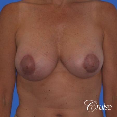 best breast lift donut pictures on mature woman - After Image 1