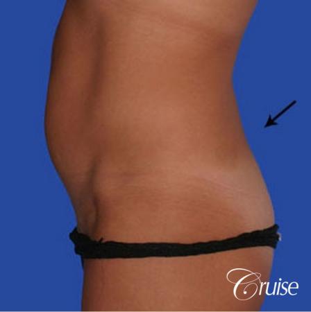 best female lipo results - Before and After Image 2