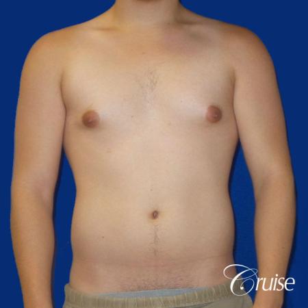 Best Gynecomastia surgeons Southern California - Before Image 1