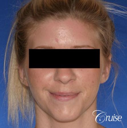 best otoplasty photos by top plastic surgeon - After Image 1
