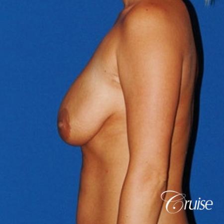 best breast lift anchor with saline implants - Before and After Image 2