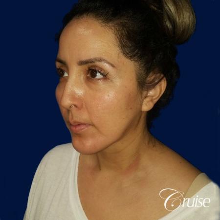 Liposuction of Neck/Jawline - After Image 3