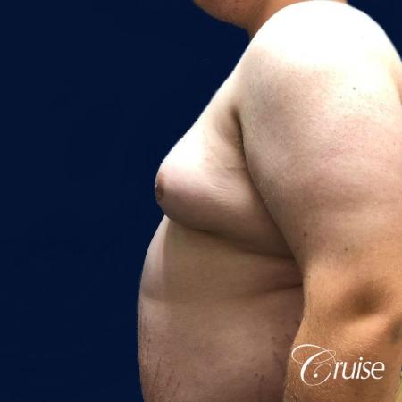 male breast reduction surgery orange county - Before 2