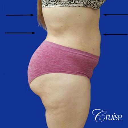 Best liposuction procedures dr cruise - After Image 4