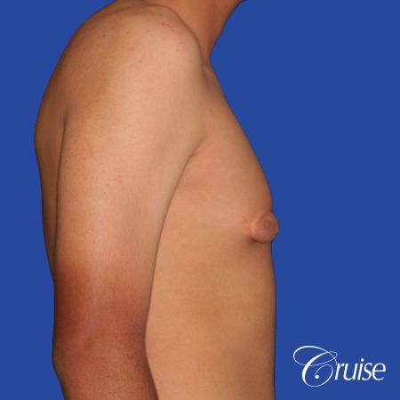 gynecomastia patient gets nipple reduction for best results - Before Image 4