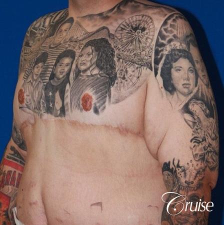 severe gynecomastia with free nipple graft on adult - After Image 3
