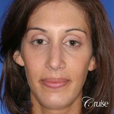 29 yr old with large female chin augmentation - After Image 1