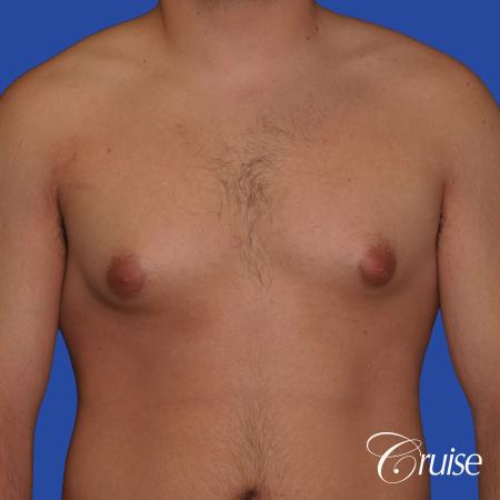 mild case of gynecomastia on adult - Before Image 1