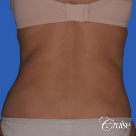 best lipo photos of love handles and stomach - After Image 2