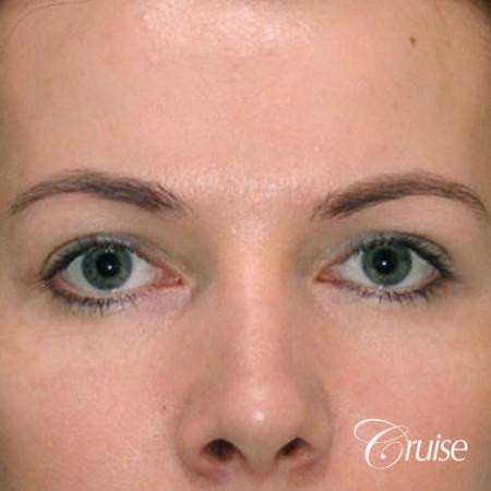 best before and after pictures of upper eyelid surgery - After Image 1