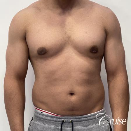 gynecomastia surgery - After 1