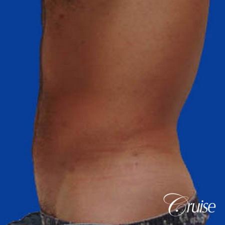 best male ab sculpting liposuction abdomen flanks - After Image 2