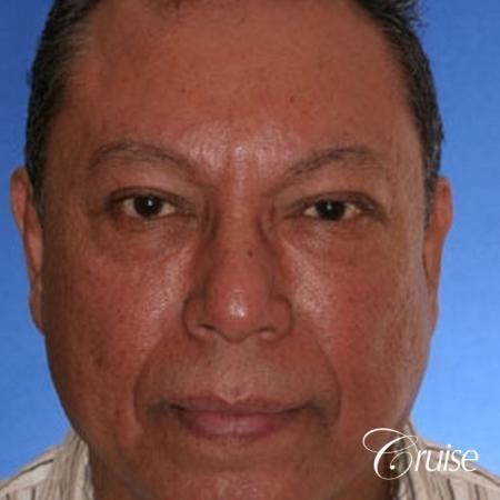 Fat Transfer - Tear Trough, Lower- Lids, Cheeks - After Image