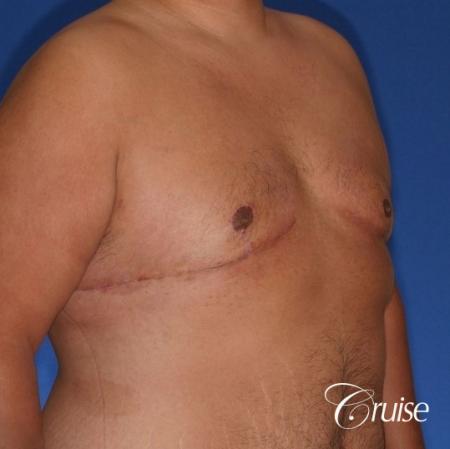 free nipple graft gynecomastia results - After Image 2