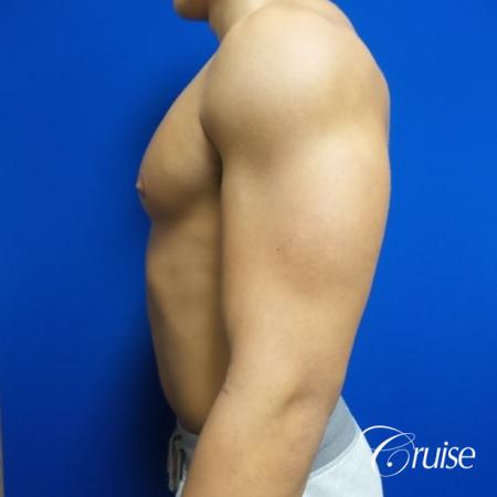 bodybuilder with gynecomastia - Before and After Image 3