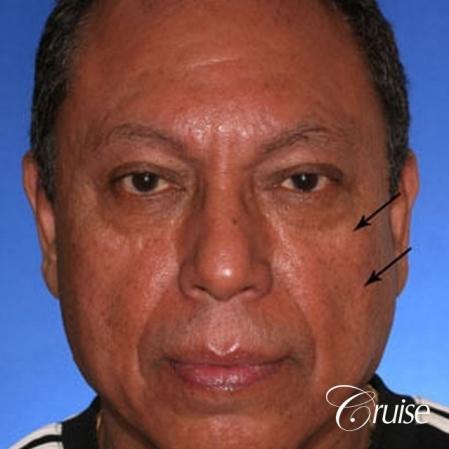 Fat Transfer - Tear Trough, Lower- Lids, Cheeks - Before Image