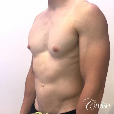 gynecomastia with puffy nipples - Before Image 3
