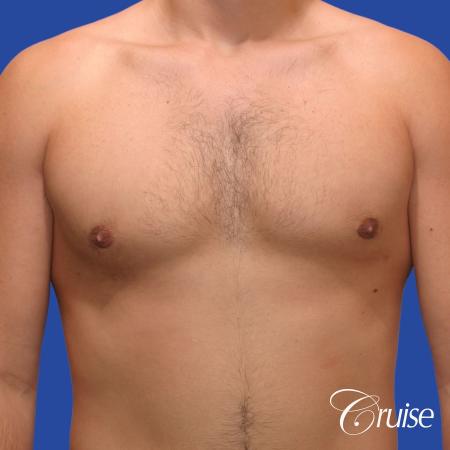 24 yr old body builder mild gynecomastia - After Image 1
