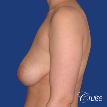 young woman who had best results for breast lift with saline implants - Before and After Image 2