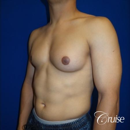 Unilateral gynecomastia before and after - Before Image 2