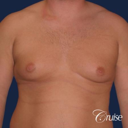donut lift Gynecomastia correction - Before Image 1