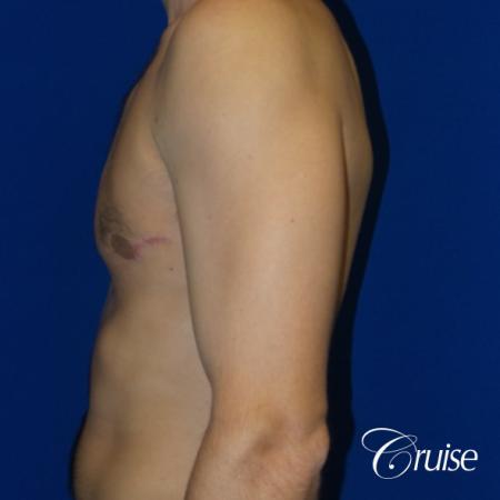 Unilateral gynecomastia - After Image 3
