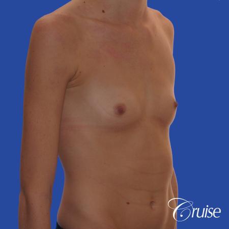 Breast Augmentation - Before Image 3