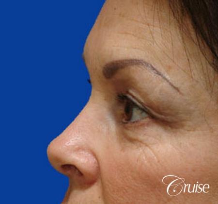 best blepharoplasty eye surgery photos - Before Image 2