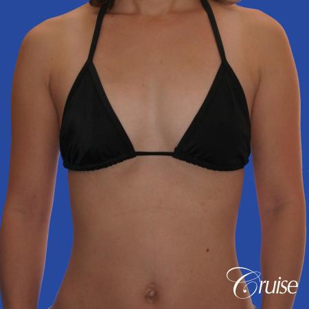 Breast Augmentation - Before and After Image 4