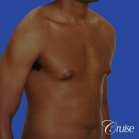 young body builder has puffy nipple and gets gynecomastia surgery - Before and After Image 4