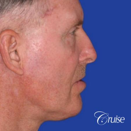 62 year old with chin implant and neck lift - After Image 3