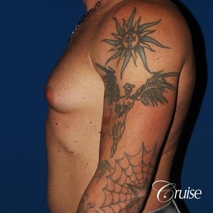 moderate gynecomastia with puffy nipple on athletic adult - Before Image 3